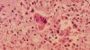 Alerta en EEUU por brote de sarampión: confirman el primer caso en San Diego