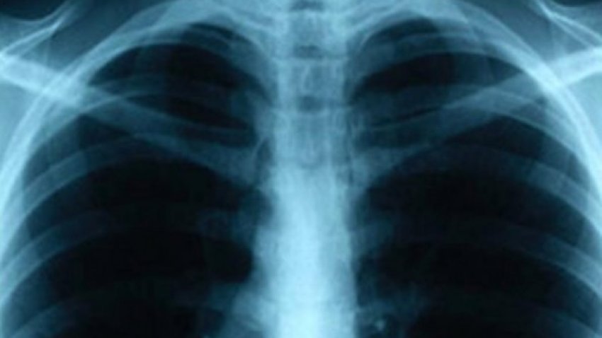Radiografía de pulmones