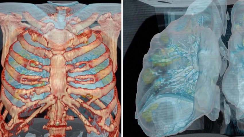 Video: los daños que provoca el coronavirus en los pulmones