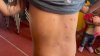 “Comezón y ardor insoportables”: 40 niños migrantes contraen varicela en albergue de Tijuana