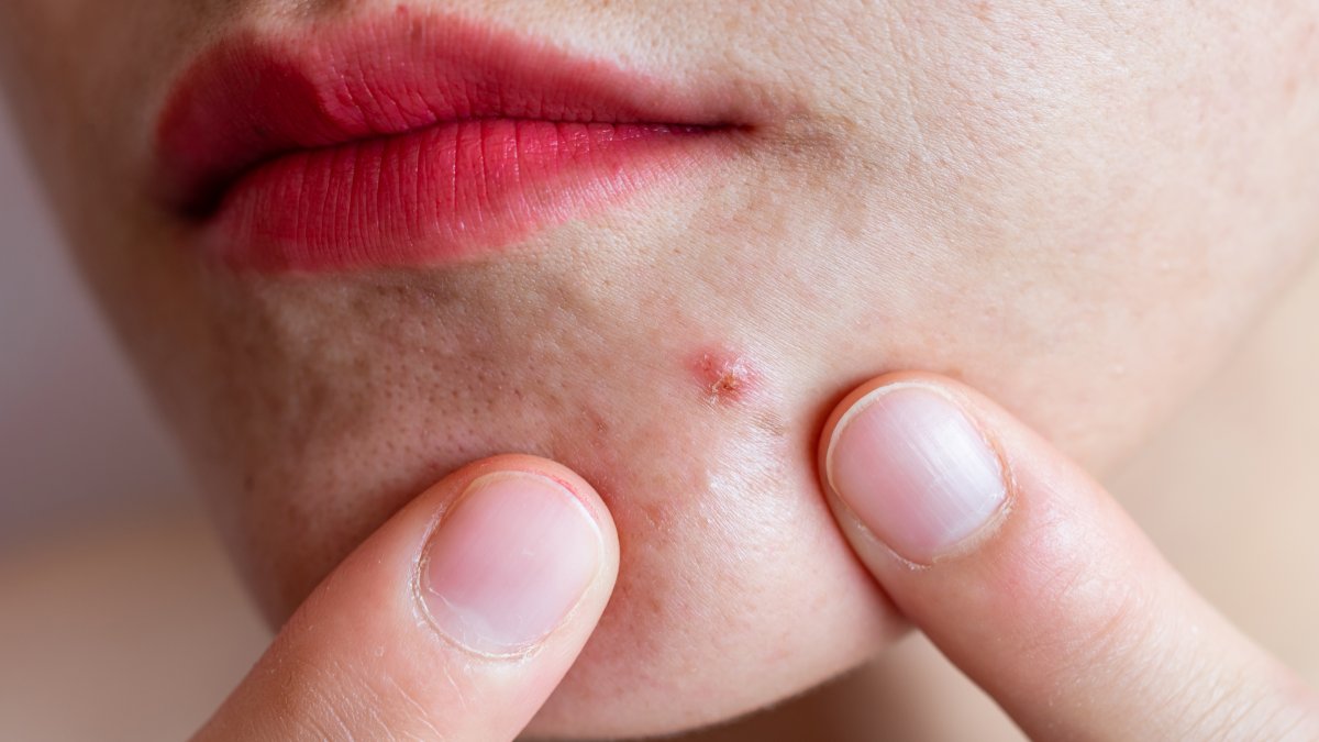 UC San Diego Researchers Develop Promising Vaccine for Acne